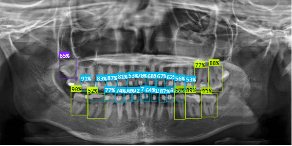 Panoramic Dental X-ray AI Project